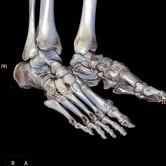 3D CT Both Foot